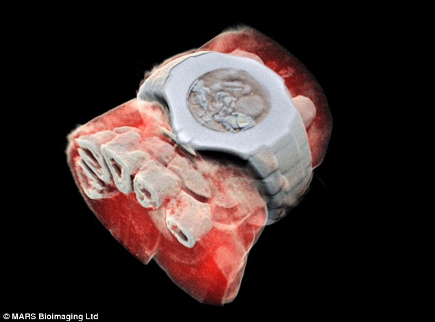 Image reveals a 3D colour X-ray of a wrist, with a watch, with bones in white and tissue in red